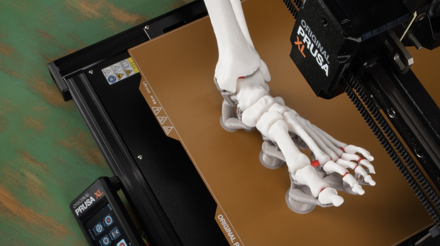 Functional prosthetic component printed using Prusa XL toolhead